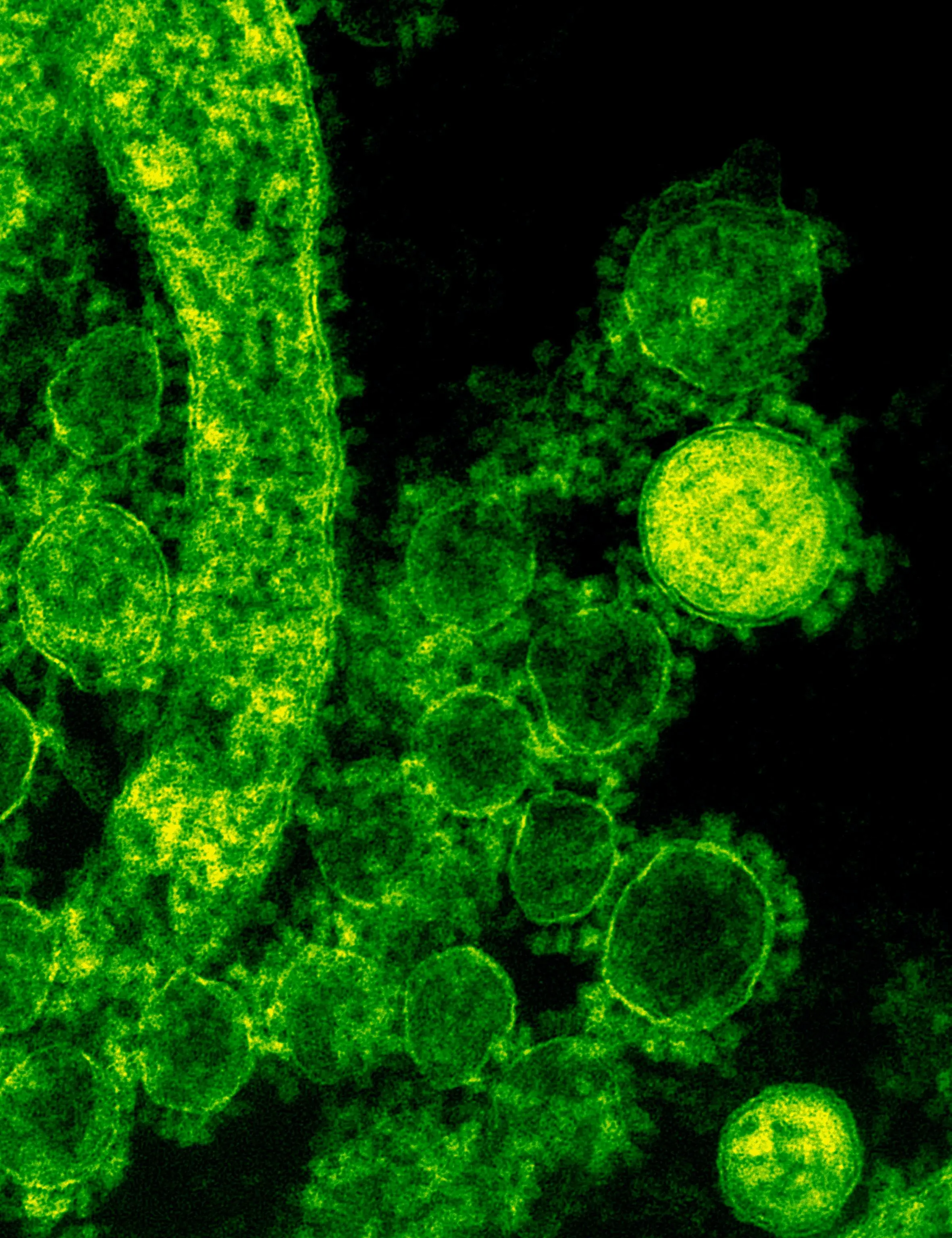 digitally colorized transmission electron microscopic (TEM) image of Sars-Cov-2 viral particles