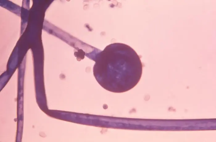 A microscopy image of a Mucormycosis sporangium